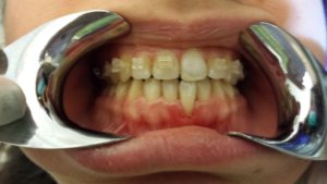 Ortodonzia fissa ed intercettiva a Catania Studio Dentistico Palmeri