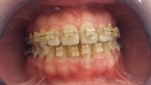 Ortodonzia fissa ed intercettiva studio dentistico a Catania Palmeri