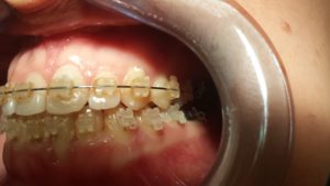 Ortodonzia fissa ed intercettiva a Catania Studio Dentistico Palmeri