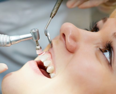 pulizia denti studio palmeri dentisti catania