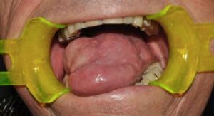 tumori cavo orale studio palmeri dentisti catania