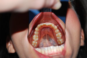Ortodonzia invisibile a Catania Studio Dentistico Palmeri