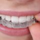 Un sorriso a prova di Hollywood con l’ortodonzia invisibile: Studio Dentistico Palmeri