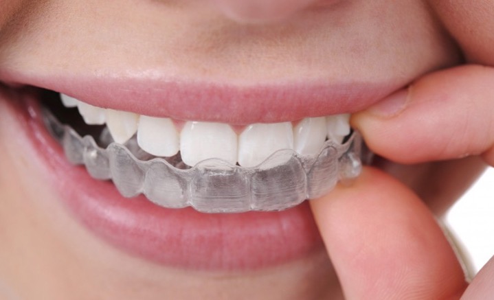 Un sorriso a prova di Hollywood con l’ortodonzia invisibile: Studio Dentistico Palmeri