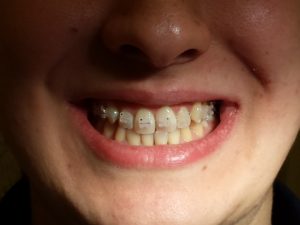 Ortodonzia fissa ed intercettiva studio dentistico a Catania Palmeri