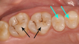 Sigillatura dei solchi: Studio Dentistico Palmeri