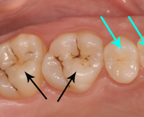 Sigillatura dei solchi: Studio Dentistico Palmeri