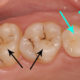 Sigillatura dei solchi: Studio Dentistico Palmeri