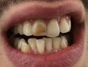 Ortodonzia invisibile a Catania Studio Dentistico Palmeri