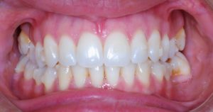 Ortodonzia invisibile a Catania Studio Dentistico Palmeri