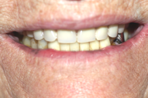 Protesi fissa inferiore metallo ceramica su denti naturali a Catania Studio Palmeri