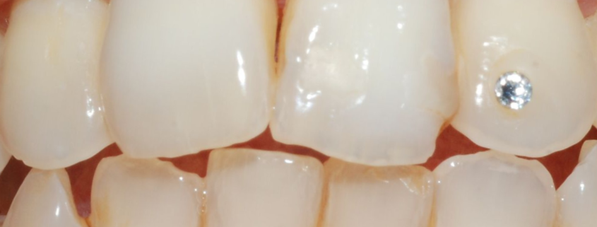 Ricostruzione dente a Catania Studio Dentistico Palmeri
