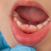 bambini con denti storti che hanno bisogno di apparecchio ai denti