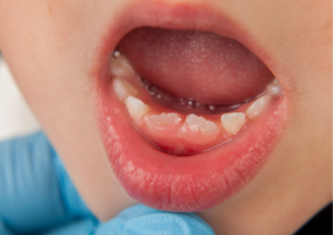 bambini con denti storti che hanno bisogno di apparecchio ai denti