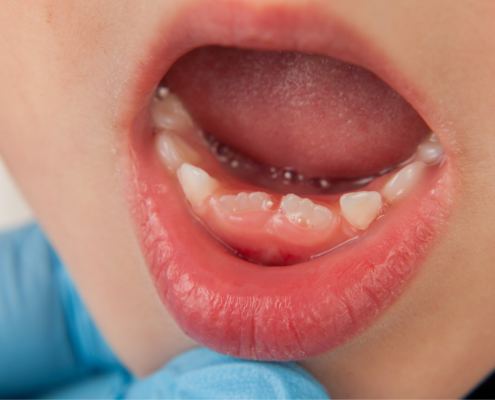 bambini con denti storti che hanno bisogno di apparecchio ai denti