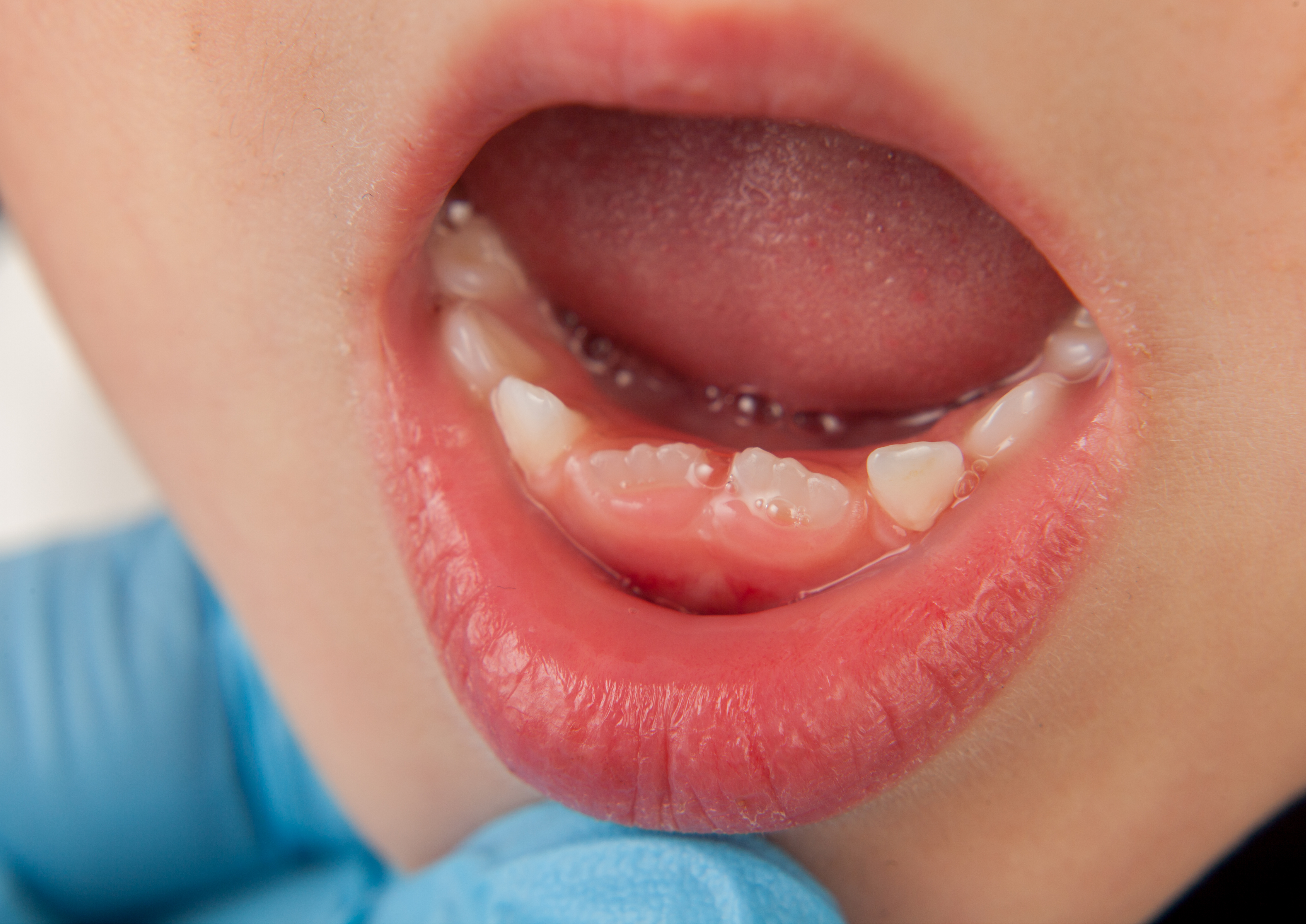Faccette dentali: quello che c'è da sapere – Studio Palmeri
