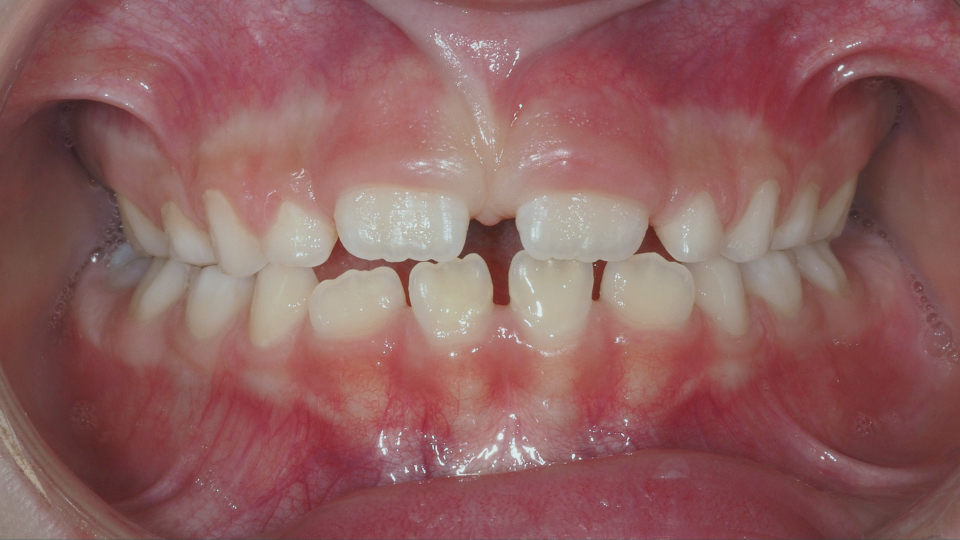 ortodonzia intercettiva