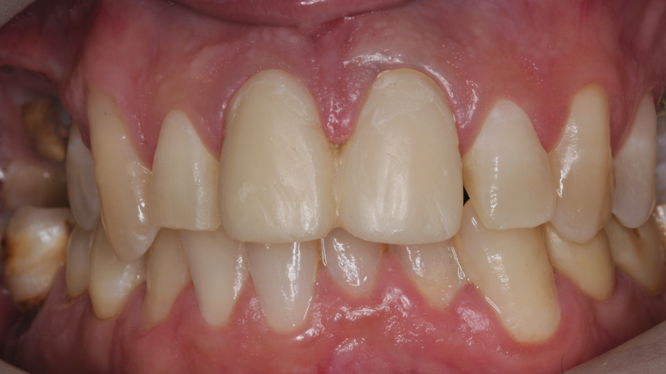 immagine incisivi dopo il trattamento con faccette dentali in ceramica