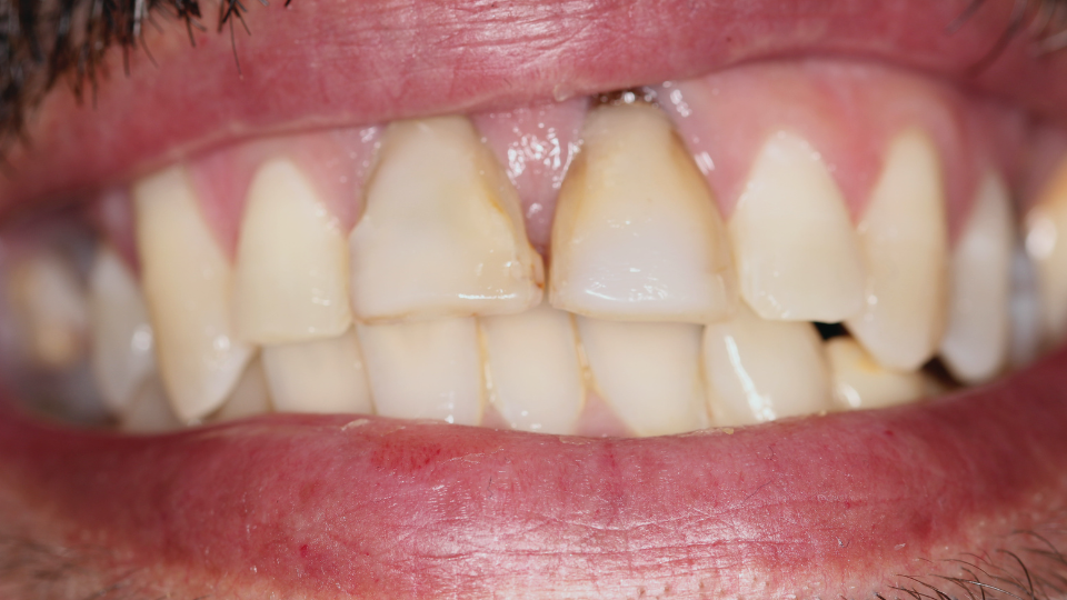 immagine incisivi prima del trattamento con faccette dentali