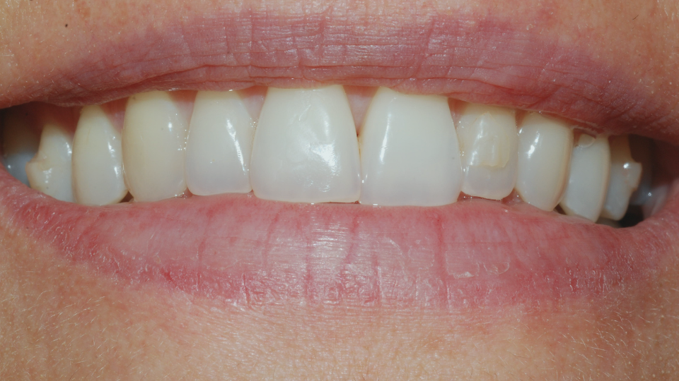 Trattamento di ortodonzia invisibile Invisalign