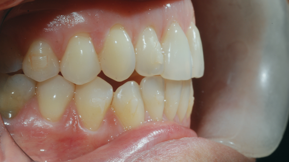 Trattamento di ortodonzia invisibile Invisalign