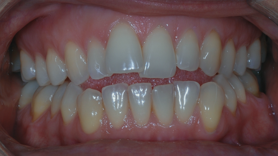 Trattamento di ortodonzia invisibile Invisalign