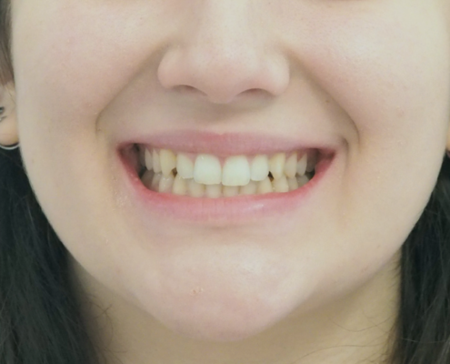 Caso di riallineamento dentale con mascherine invisibili Invisalign