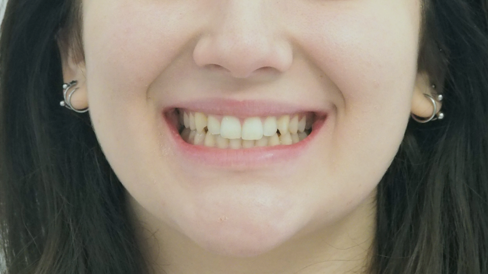 Caso di riallineamento dentale con mascherine invisibili Invisalign