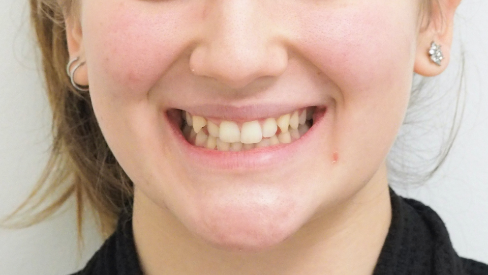 Caso di riallineamento dentale con mascherine invisibili Invisalign