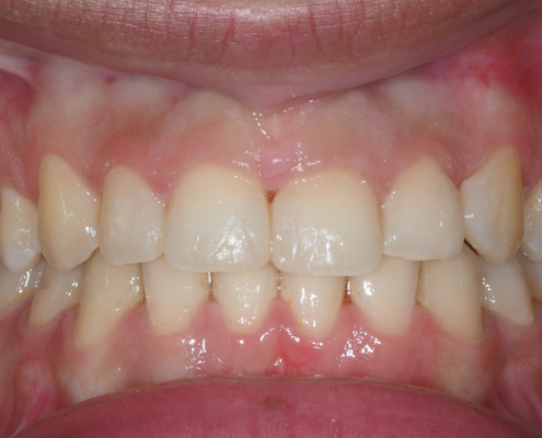 risultati ortodonzia fissa