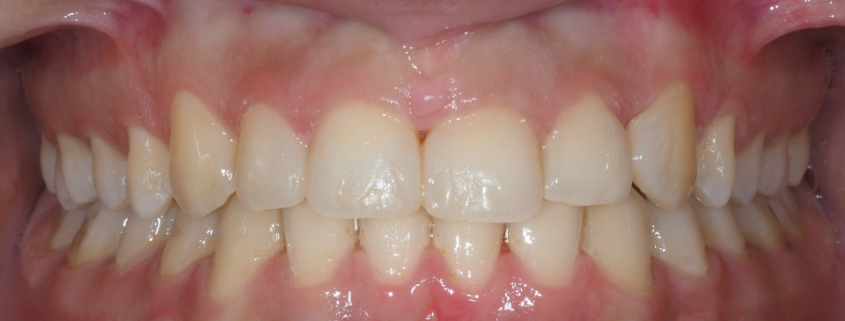 risultati ortodonzia fissa