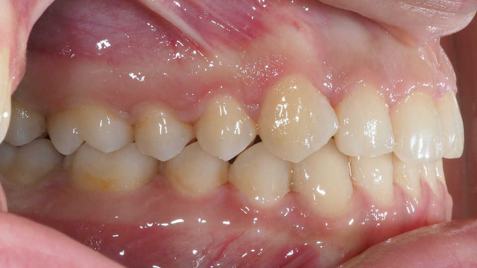 risultato post trattamento ortodonzia fissa
