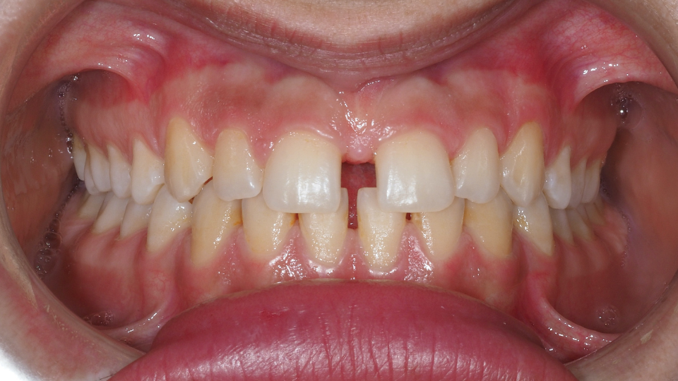 diastema incisivi separati